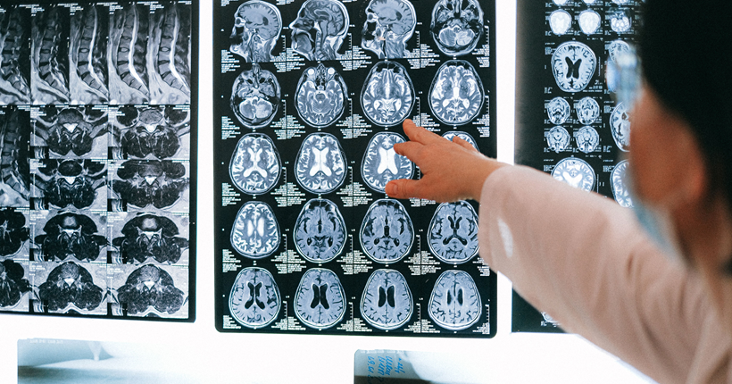 ¿Qué es lo que realmente sucede cuando me diagnostican de alzhéimer? Entendiendo la enfermedad desde el cerebro