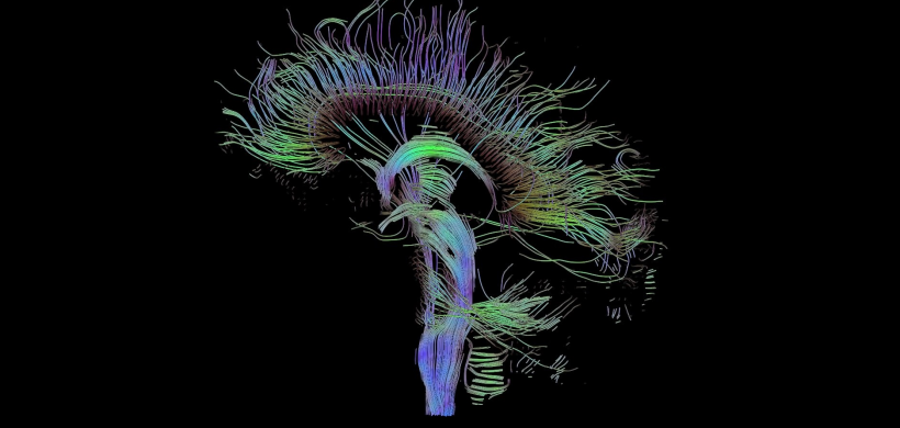 Imagen de tensor de difusión (Tractografía) en demencia tipo Alzheimer