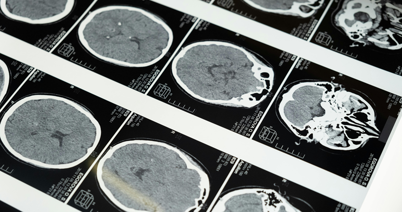 Imagen de escáner cerebral